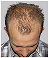 Bosley patient Jason before