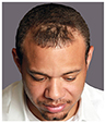 Bosley patient Troy before