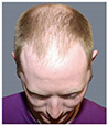 Bosley patient Blair before