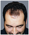 Bosley patient Dean before