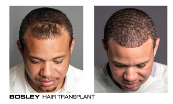 Bosley patient before and after