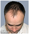 Bosley patient John B before