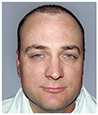 Bosley patient Joshua A before