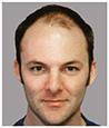 Bosley patient Steve A before