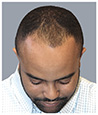 Bosley patient Wayne before