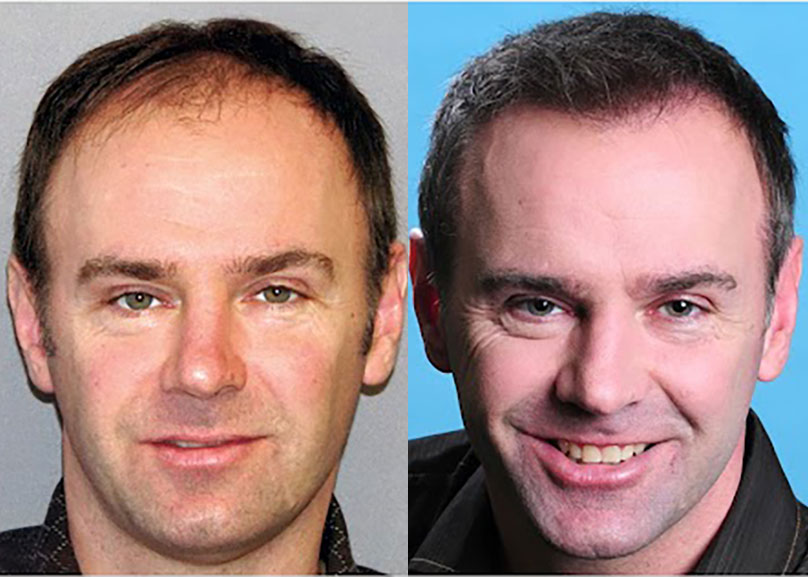Bosley patient Robert B before and after