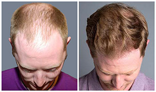 Bosley patient Blair before and after