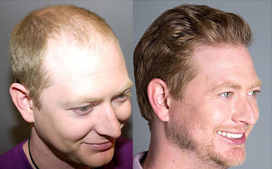 Bosley patient Blair T before and after