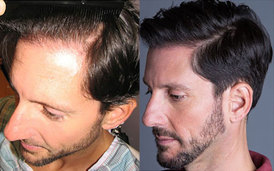 Bosley patient Brian P before and after