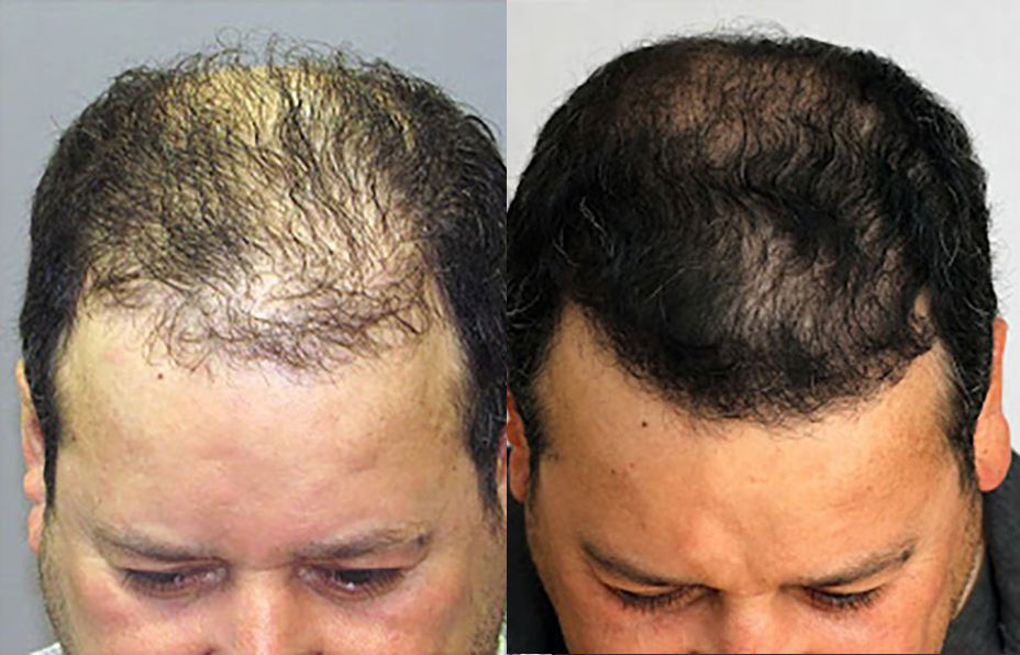 Bosley patient Carlos R. before and after