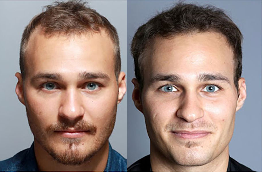 Bosley patient Cayle D before and after