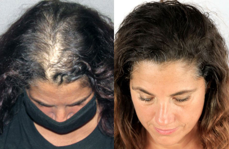 Bosley patient Charlene D. before and after