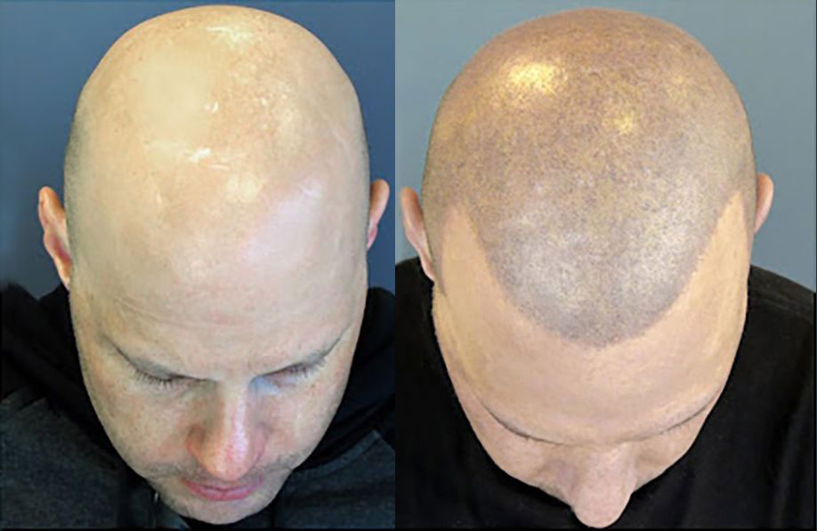 Bosley patient Chris B. before and after
