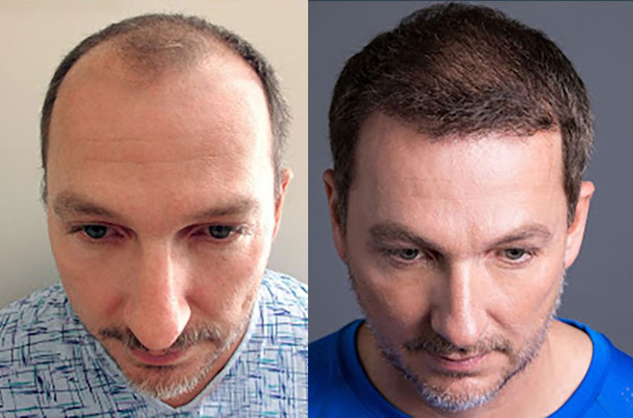 Bosley patient Chuck I before and after