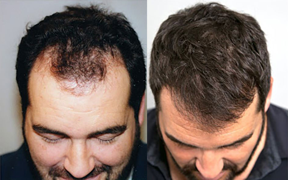 Bosley patient Dean B before and after