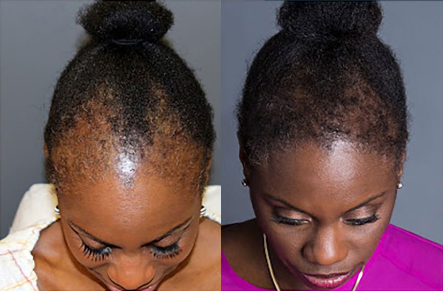 Bosley patient Delania before and after