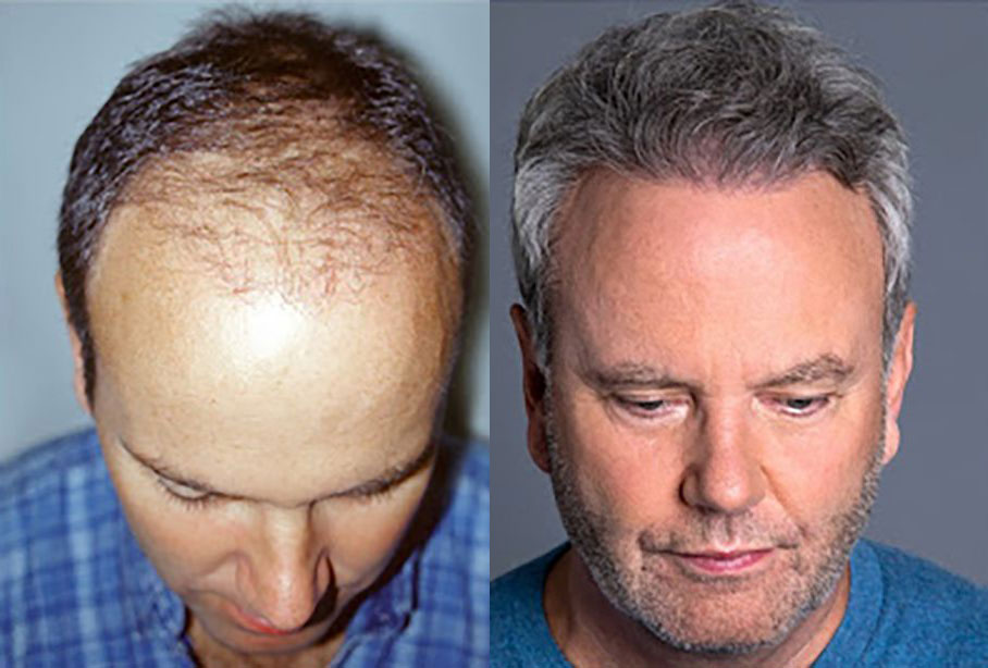Bosley patient Drake V before and after