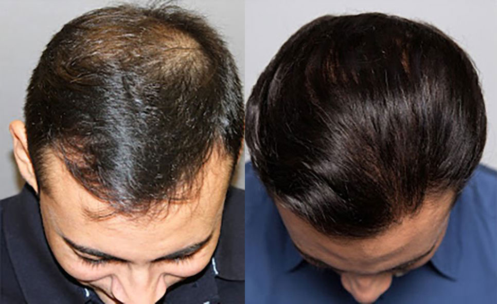Bosley patient Ernic R before and after