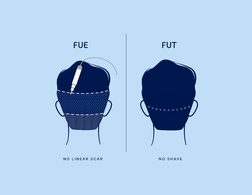 Illistration of follicular unit extraction and follicular unit transplantation