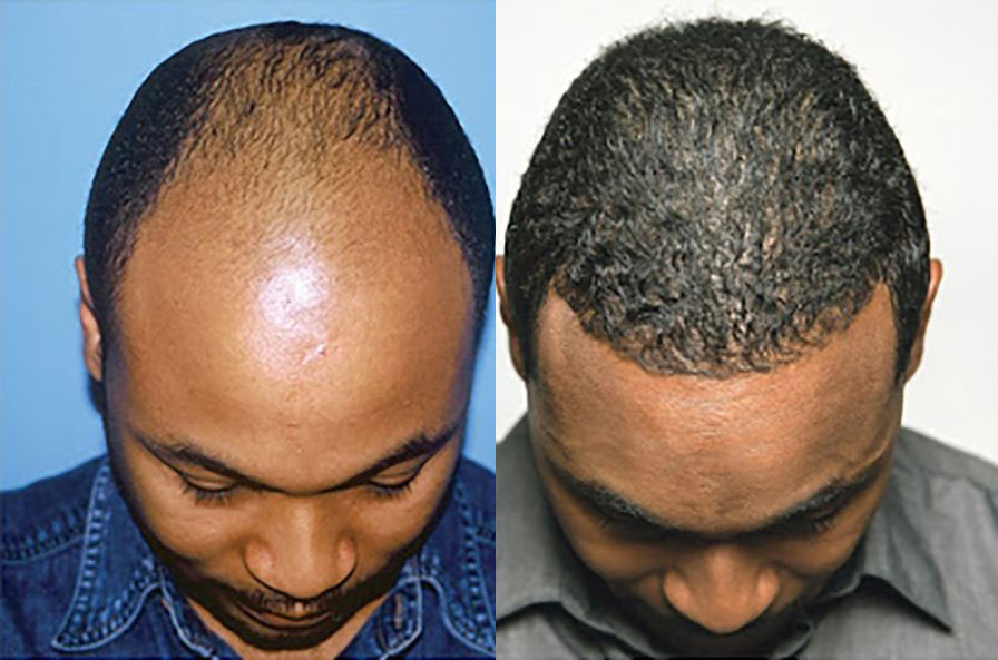 Bosley patient Gerald R before and after