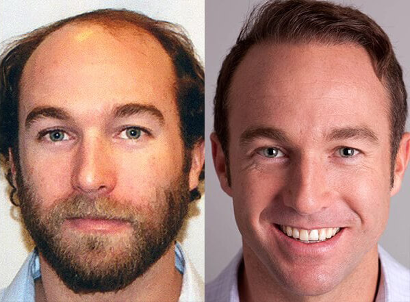 Bosley patient before and after