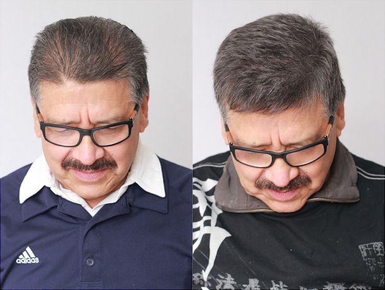 Bosley patient Ismael D before and after