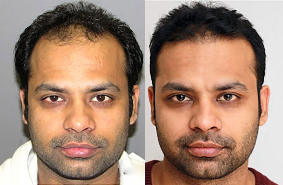 Bosley patient Jaikishan Y before and after