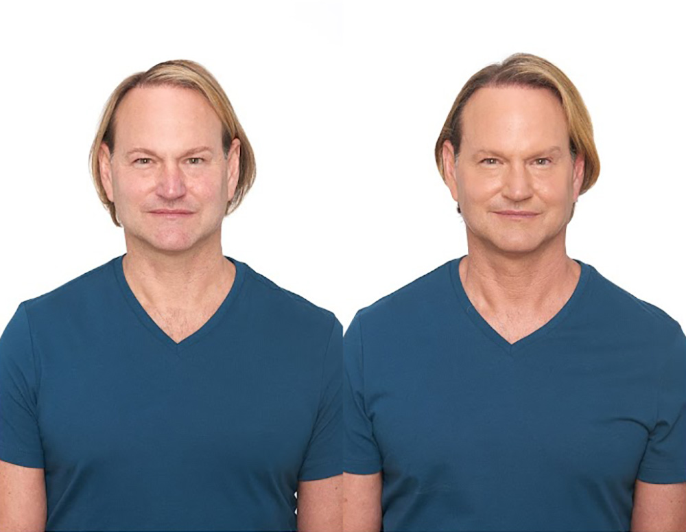 Bosley patient James P before and after