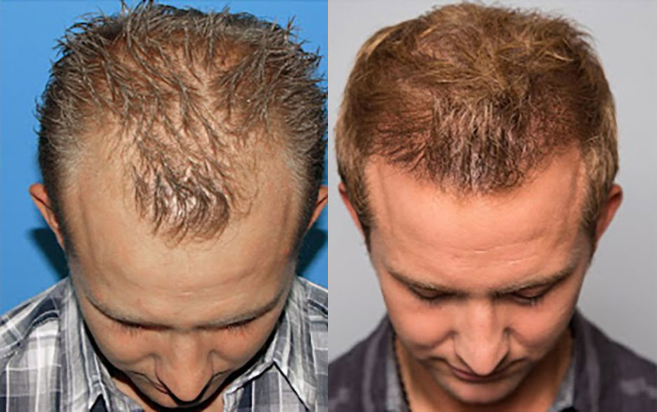 Bosley patient Jason W before and after