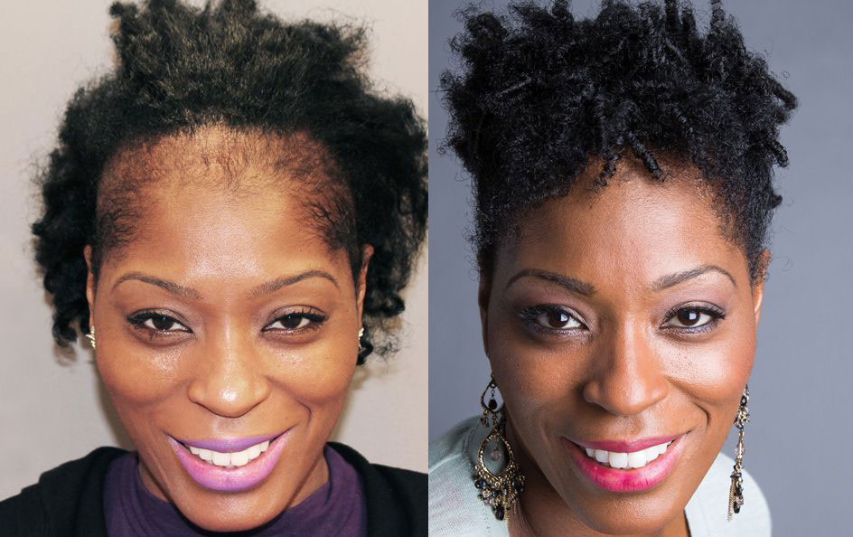 Bosley patient Jewel S. before and after