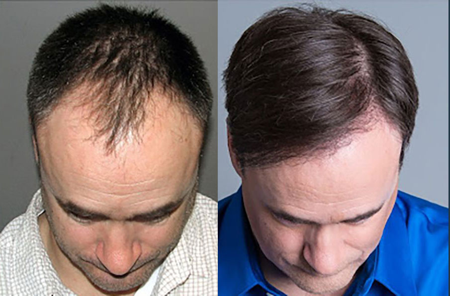 Bosley patient John B before and after