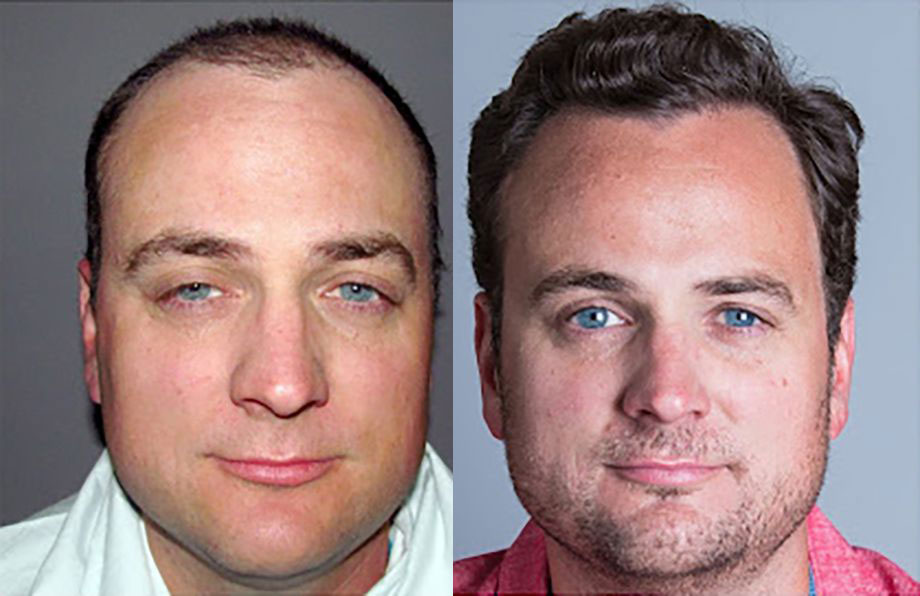 Bosley patient Joshua A before and after