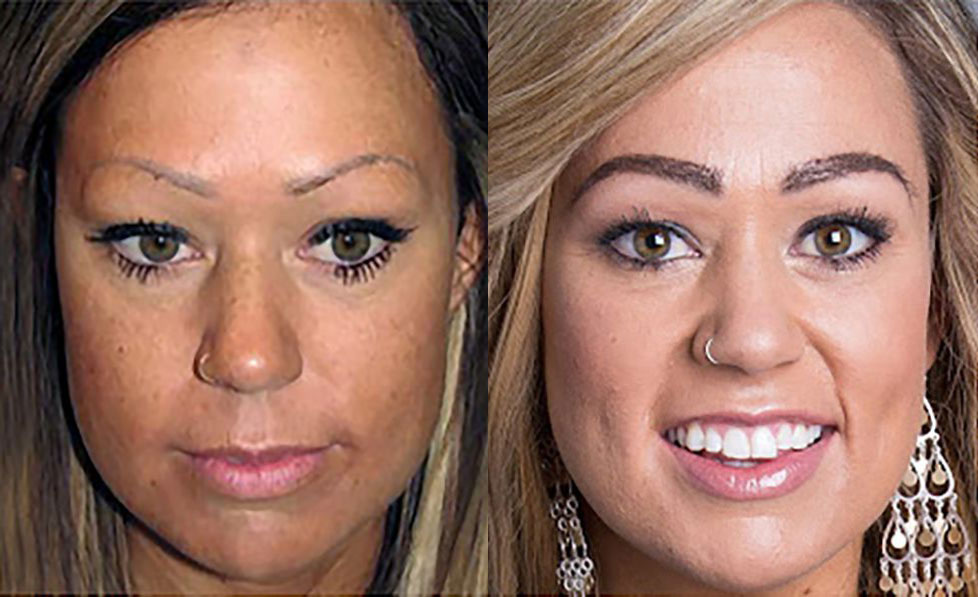 Bosley patient Juliann before and after