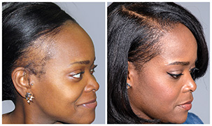 Bosley patient Britany G. before and after