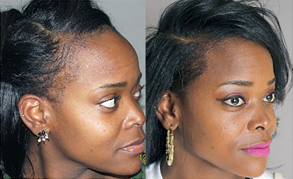 Bosley patient Kelly before and after