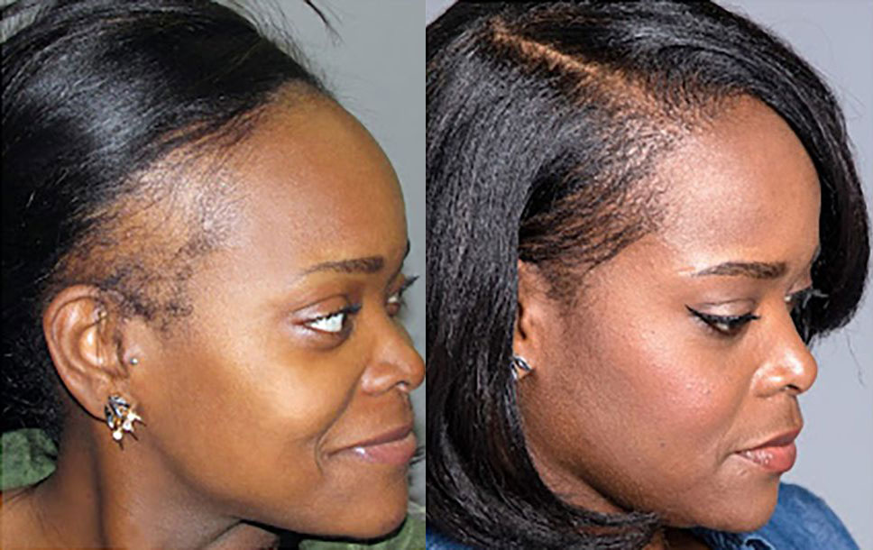 Bosley patient Kelly S. before and after