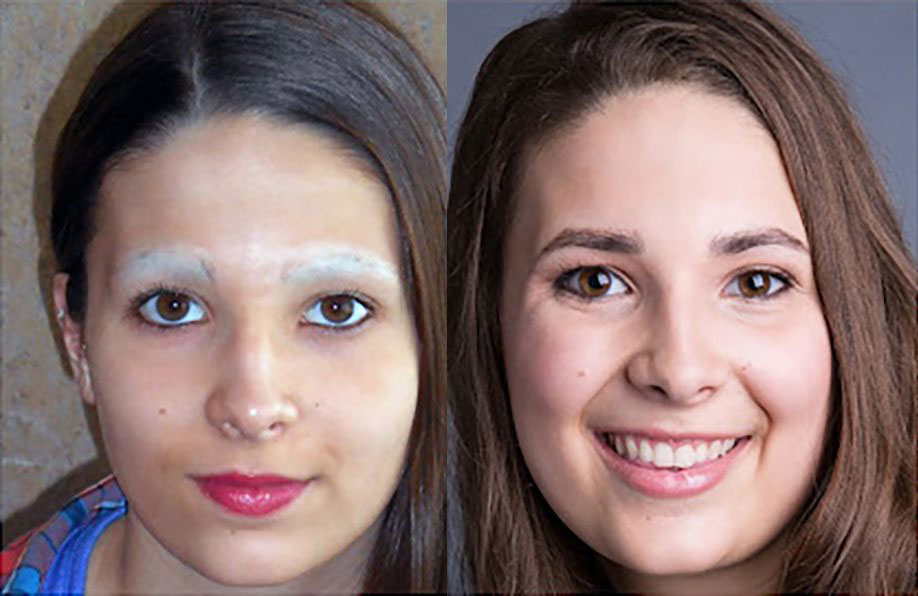 Bosley patient Kristin M. before and after