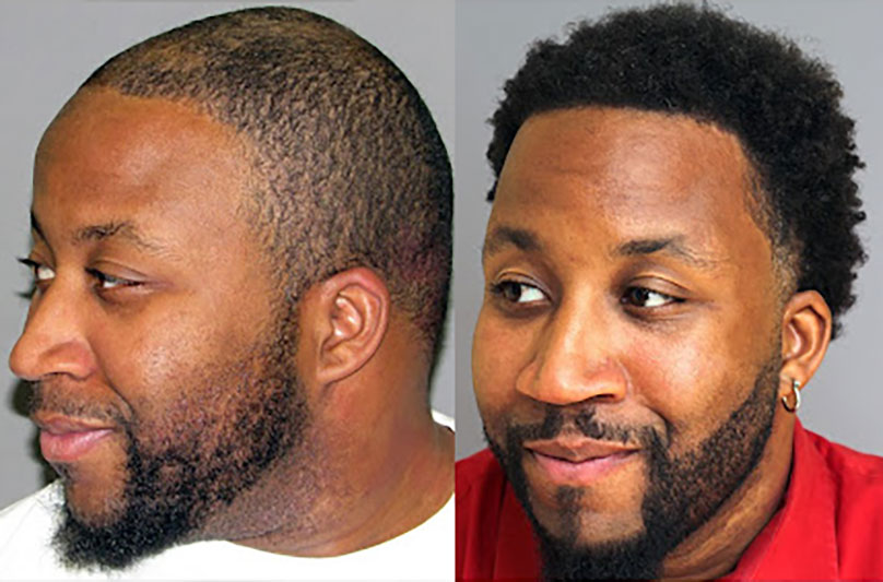 Bosley patient Lance H before and after