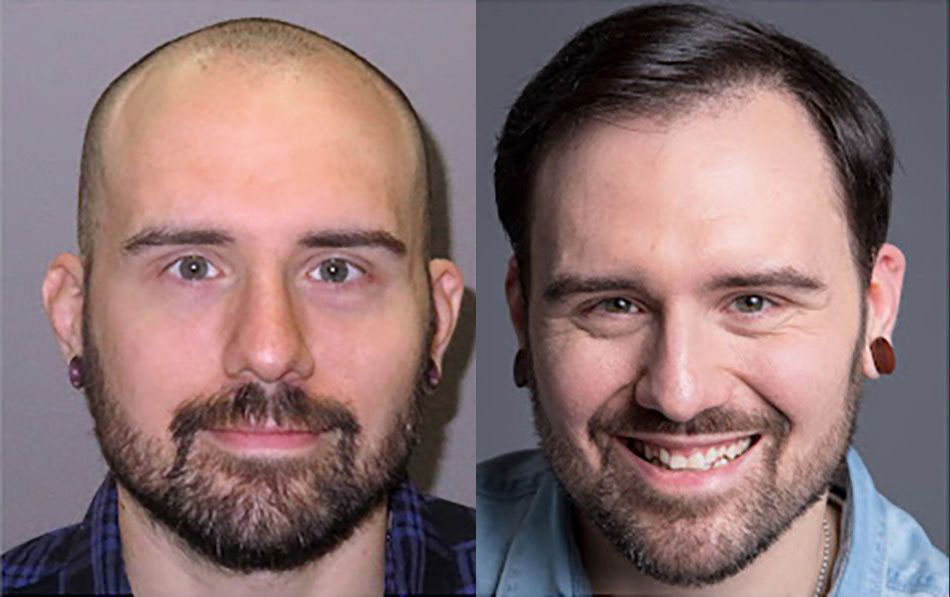 Bosley patient Luke K before and after