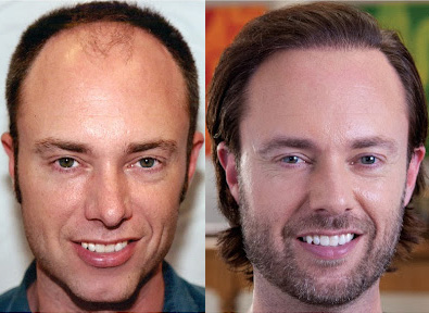 Bosley patient Marc B before and after