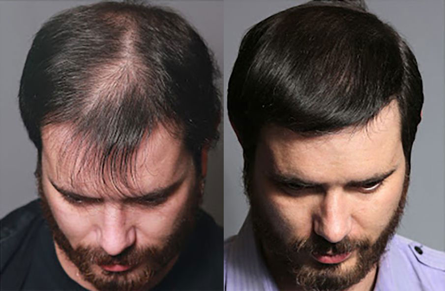 Bosley patient Matt M before and after