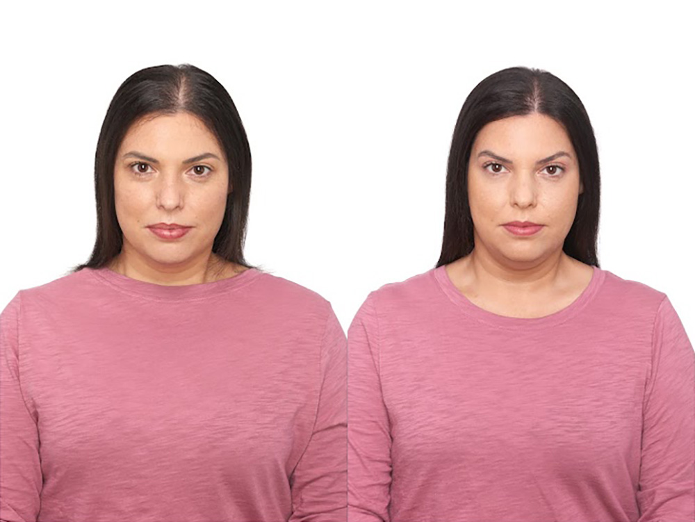 Bosley patient Michelle P before and after