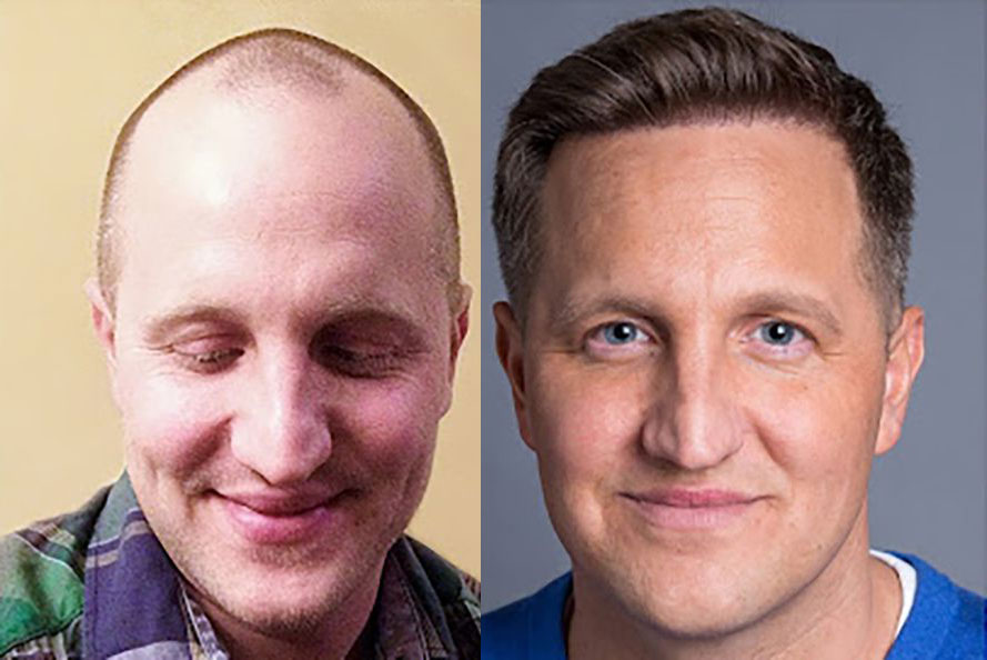 Bosley patient Nick H before and after