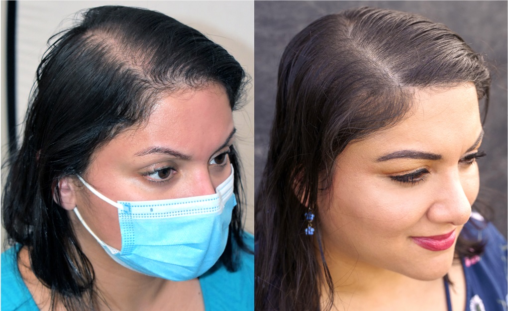 nihara-f-before-after