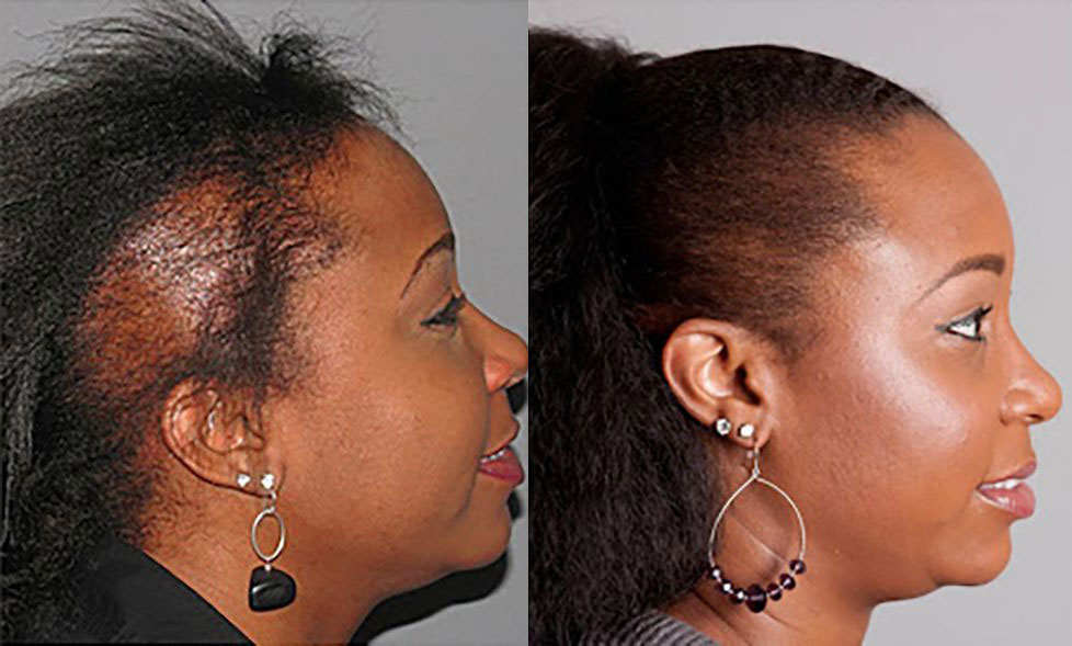 Bosley patient Nita before and after