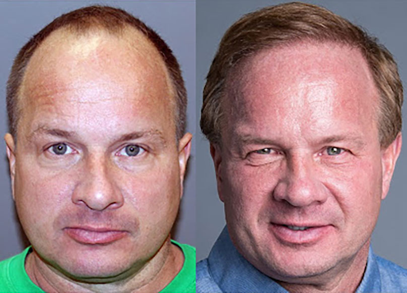 Bosley patient Ron B before and after