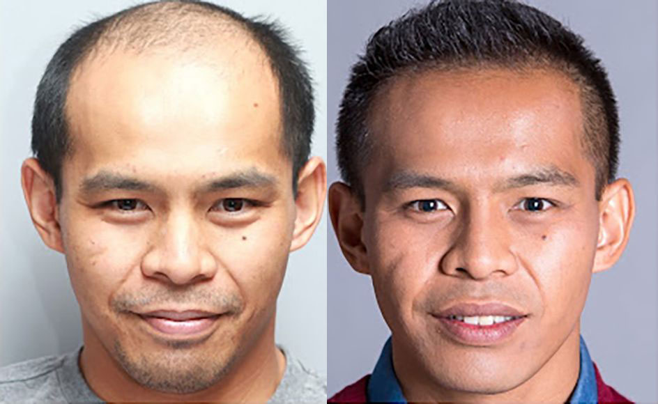 Bosley patient Ron C before and after