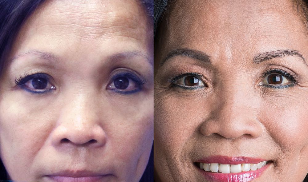 Bosley patient Rowena R before and after
