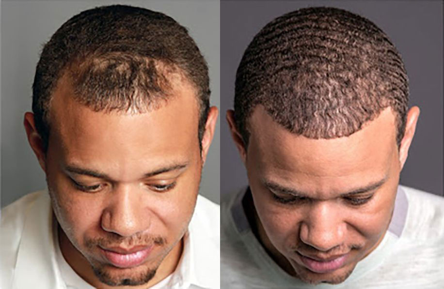 Bosley patient Troy P before and after