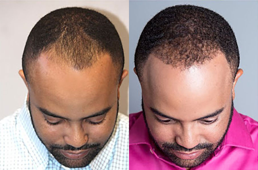 Bosley patient Wayne C before and after
